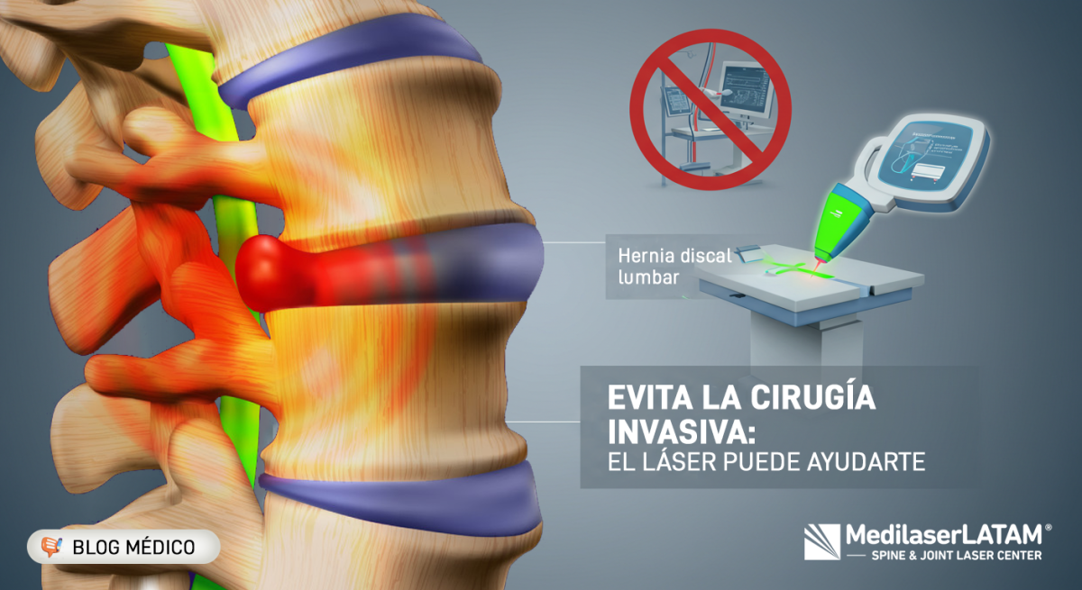 Hernia discal: síntomas, causas y tratamientos no quirúrgicos. El láser médico alivia el dolor sin cirugía. ¡Descubre más!