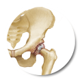 Alivia el dolor de cadera por artrosis o pinzamientos con láser. Técnica ambulatoria, sin cortes y con resultados en semanas.