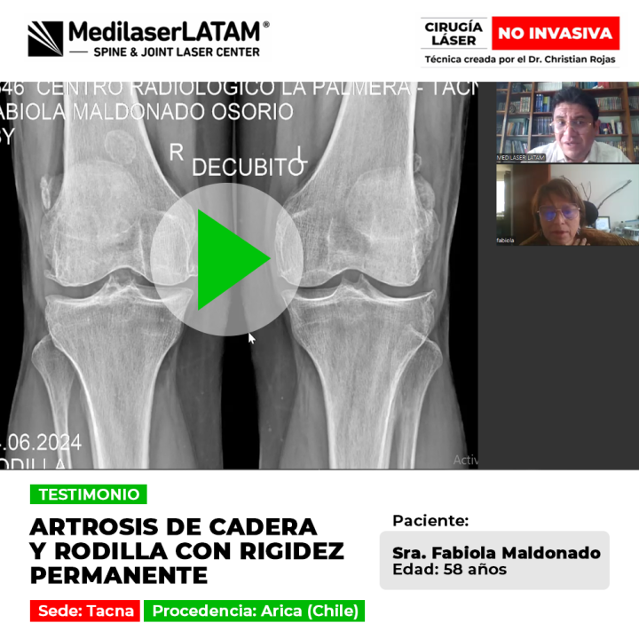 Testimonio de Fabiola Maldonado: Cirugía láser no invasiva para Artrosis de cadera y rodilla con rigidez permanente