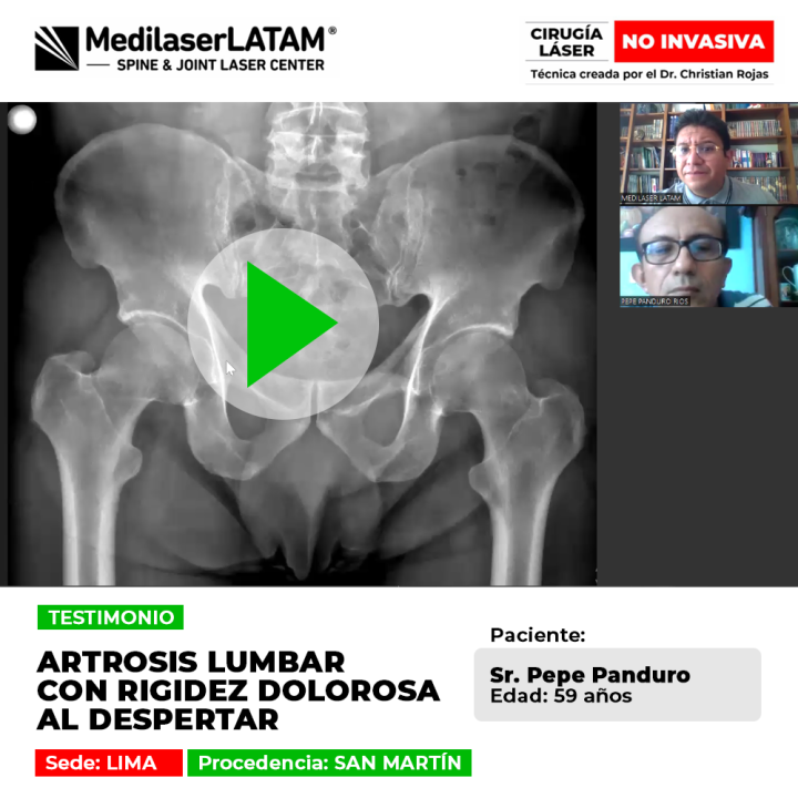 Pepe Panduro (San Martín, Perú) cuenta cómo el tratamiento láser resolvió su artrosis lumbar y la rigidez dolorosa que sentía cada mañana.
