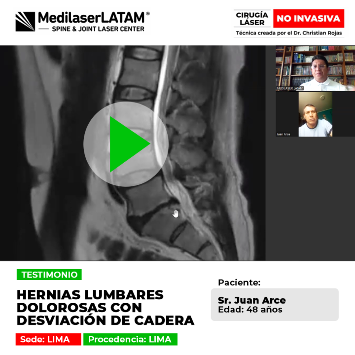 Conozca el caso de Juan Arce (Lima) con hernias lumbares que causaban desviación de cadera. Vea cómo el tratamiento láser devolvió la alineación y el alivio.
