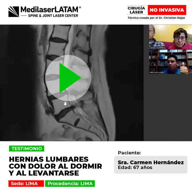 Hernias dolor nocturno y dificultad al despertar afectaban a Carmen Hernández. Vea su alivio con cirugía láser no invasiva en Medilaser LATAM.