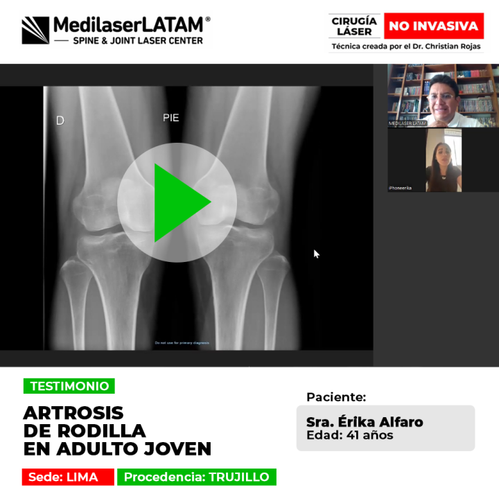Testimonio de Érika Alfaro (41): la artrosis rodilla joven no detuvo su vida. Conozca su historia de recuperación sin cirugía mayor.