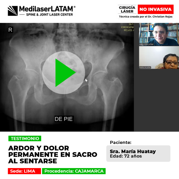 Dolor sacro sentarse: María Huatay (72) sufría ardor permanente en el sacro. Vea cómo la cirugía láser no invasiva frena el deterioro articular y eliminó su dolor.