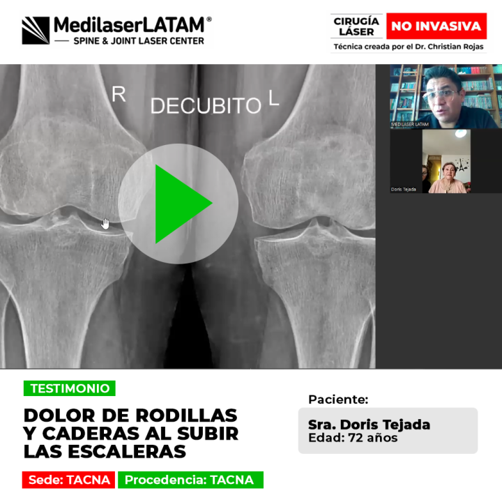 Dolor rodillas escaleras: Doris Tejada (72) venció el dolor en sus rodillas y caderas. Vea cómo la cirugía láser no invasiva frena el deterioro articular y devuelve la movilidad.