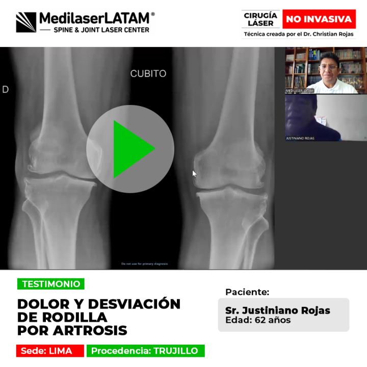 Vea este testimonio: Artrosis Desviación Rodilla en Justiniano Rojas (62). La cirugía láser frena el deterioro y corrige la desviación articular.