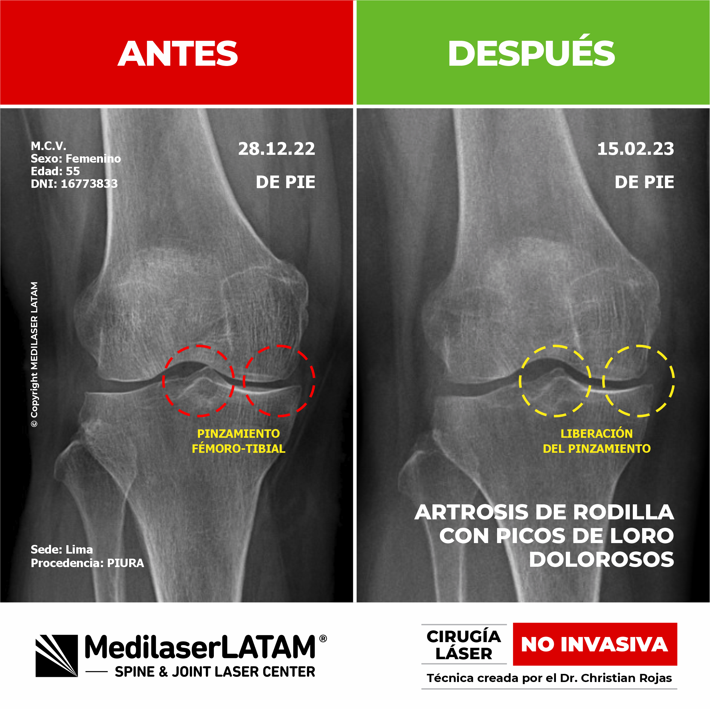 Regresión de gonartrosis derecha en Maritza Castro. Conozca el tratamiento efectivo y NO INVASIVO del Dr. Christian Rojas.