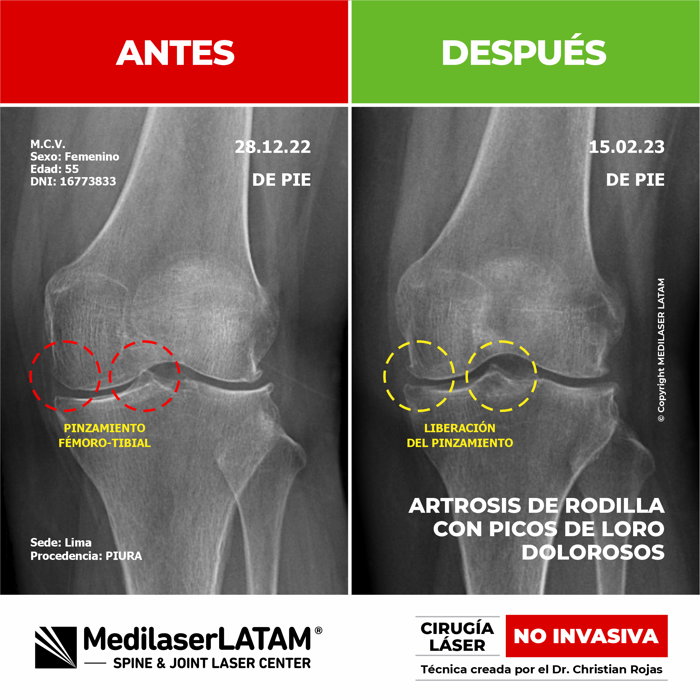 Regresión de gonartrosis izquierda en Ritza Castro documentada con imagenología. La Cirugía Láser como solución NO INVASIVA