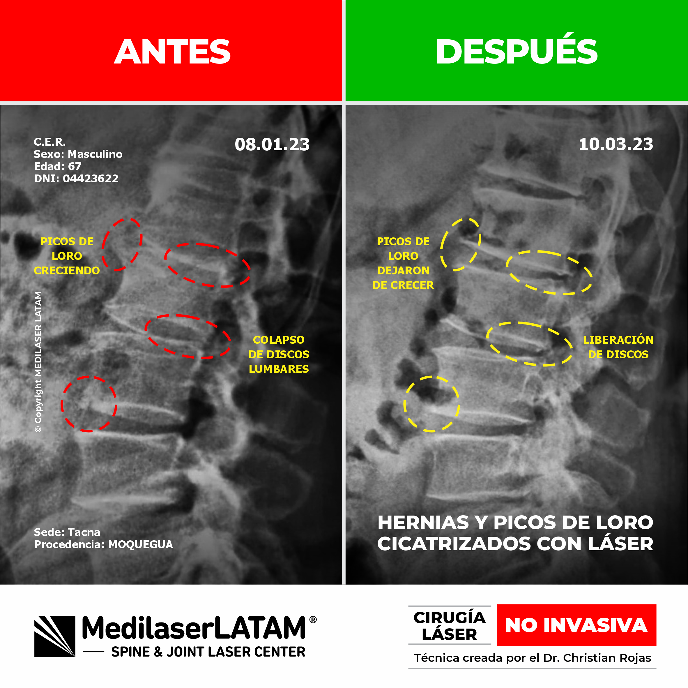 regresión de espondiloartrosis en Asimiro Espinal. Resultados comprobados con la Cirugía Láser NO INVASIVA.