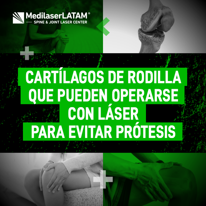 Cartílagos rodilla láser: Descubre cómo la cirugía láser no invasiva puede reparar el cartílago dañado y salvarte de la necesidad de una prótesis.