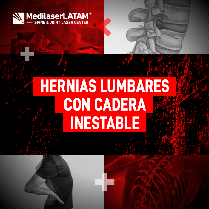 Hernias cadera inestable: El Dr. Rojas explica la conexión entre la columna y el dolor de cadera, y cómo tratar esta inestabilidad con láser.