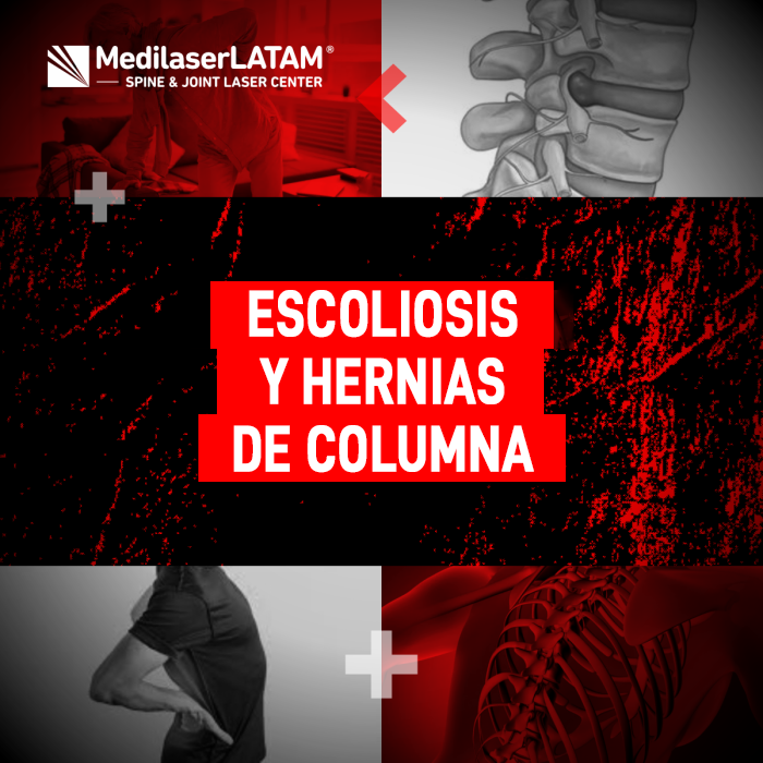 Escoliosis hernias columna: ¿Existe relación? El Dr. Rojas explica cómo la desviación espinal contribuye a la aparición de hernias y su tratamiento.