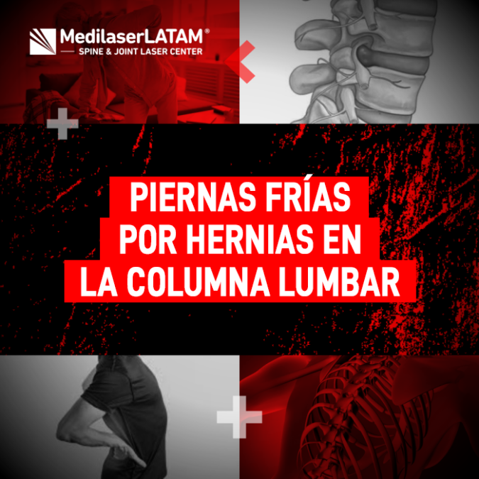 Piernas frías hernias: ¿Sientes las piernas frías o entumecidas? El Dr. Rojas explica por qué las hernias lumbares causan estos síntomas.