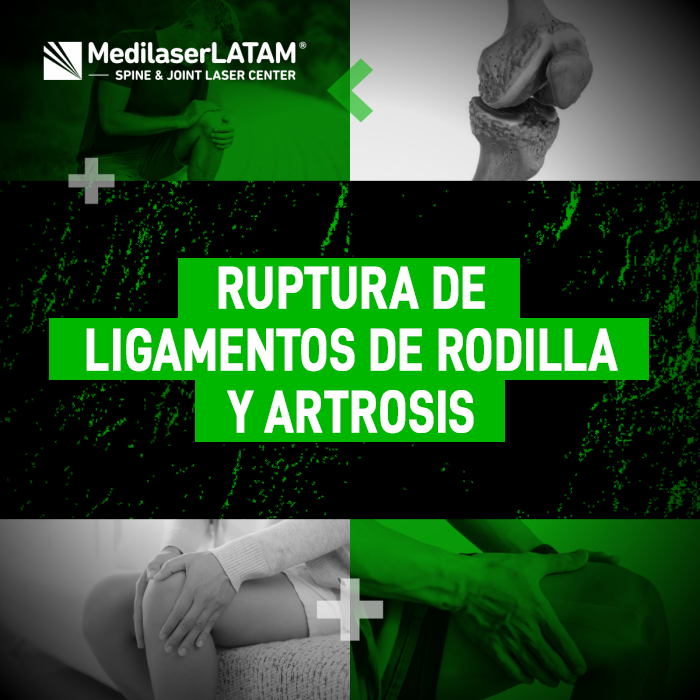 Ruptura ligamentos artrosis: Un ligamento roto genera inestabilidad que termina en artrosis. El Dr. Rojas explica cómo la cirugía láser lo previene.