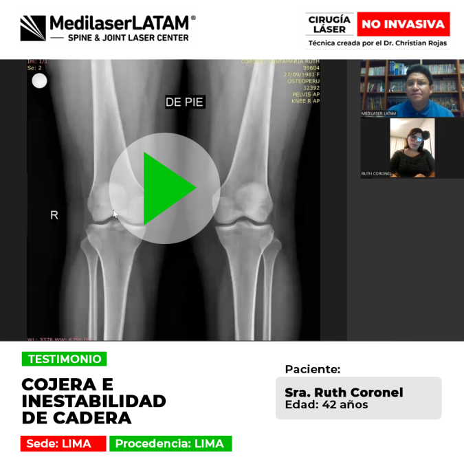Testimonio: Cojera Inestabilidad Cadera en Ruth Coronel (42). Descubra cómo la cirugía láser frena el desgaste y corrige la inestabilidad articular.