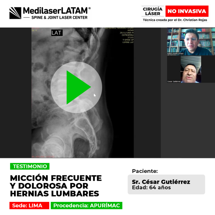 Testimonio: Micción Hernias Lumbares en Cesar Gutierrez (64). La cirugía láser no invasiva alivió el pinzamiento nervioso que causaba dolor.