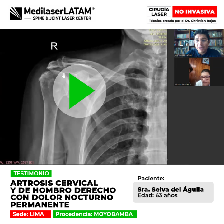 Artrosis cervical y de hombro derecho: Testimonio de la Sra. Selva Del Aguila sobre dolor nocturno en Medilaser LATAM.