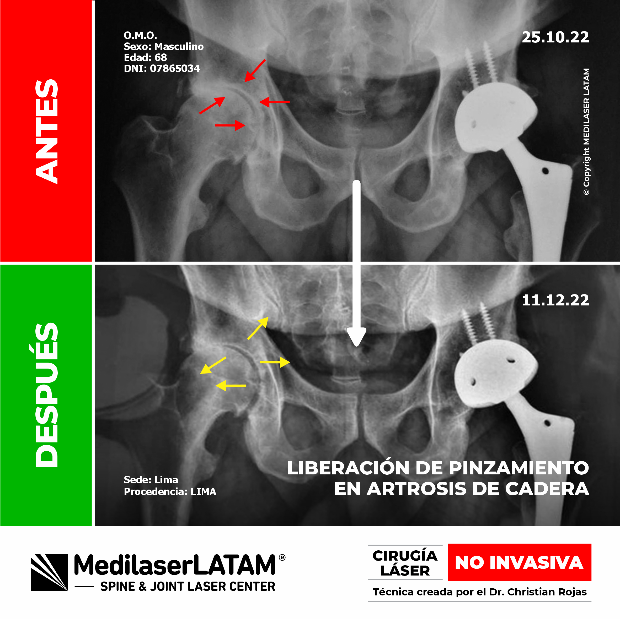 Pinzamiento Cadera: Descubre cómo se realiza la liberación del pinzamiento articular con técnicas avanzadas para tratar la Artrosis de Cadera.