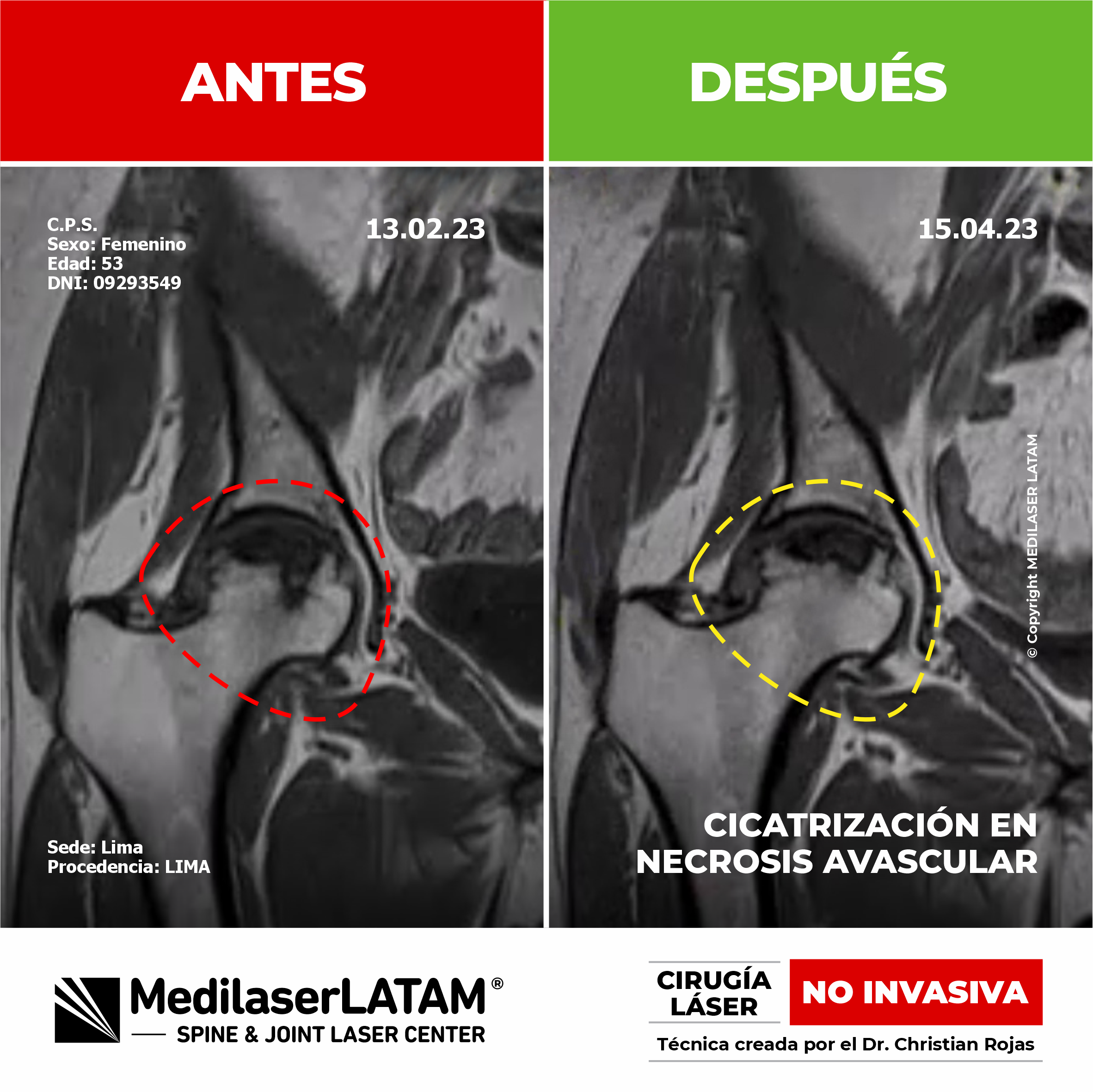 Necrosis Avascular: Entiende el proceso de cicatrización que detiene el daño y ayuda a la regeneración ósea en casos de necrosis avascular.