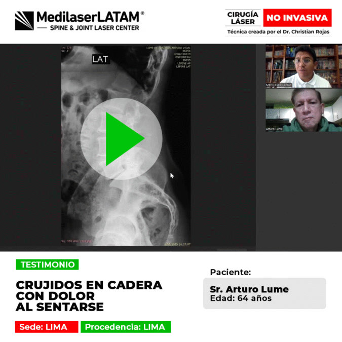 Médico radiólogo supera artrosis severa de cadera. Recuperó su espacio articular y eliminó el dolor al caminar sin cirugías abiertas.