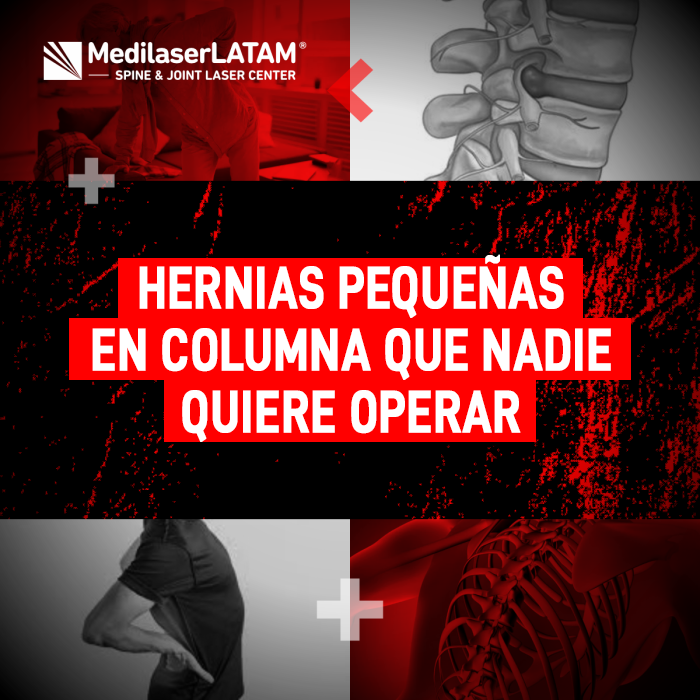Hernias pequeñas en columna que causan dolor crónico. Conozca las alternativas para tratarlas cuando la cirugía convencional no es opción.