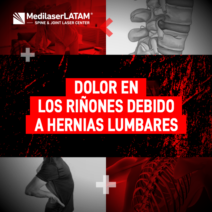 Dolor en los riñones que realmente proviene de la columna. Sepa cómo identificar si su malestar es causado por una hernia lumbar.