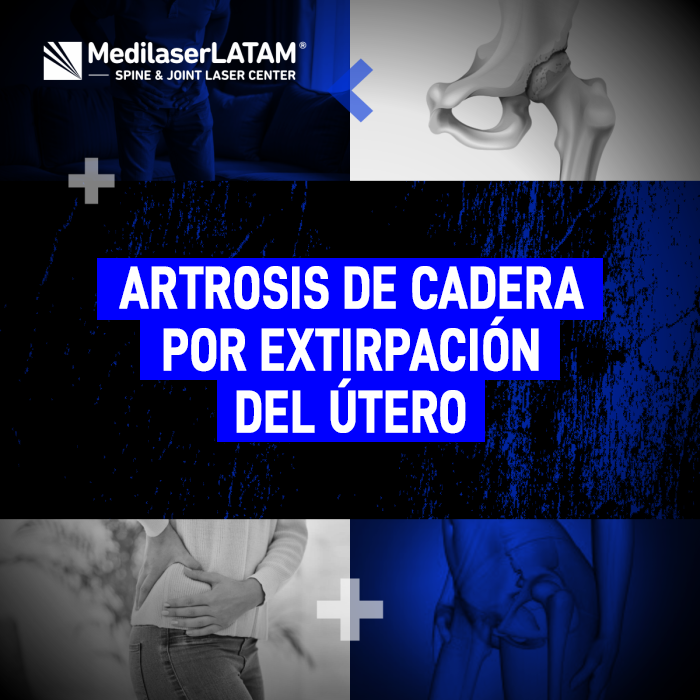 Artrosis de Cadera: conoce la relación entre la histerectomía y el daño articular severo, y cómo el láser médico puede salvar tu cadera.