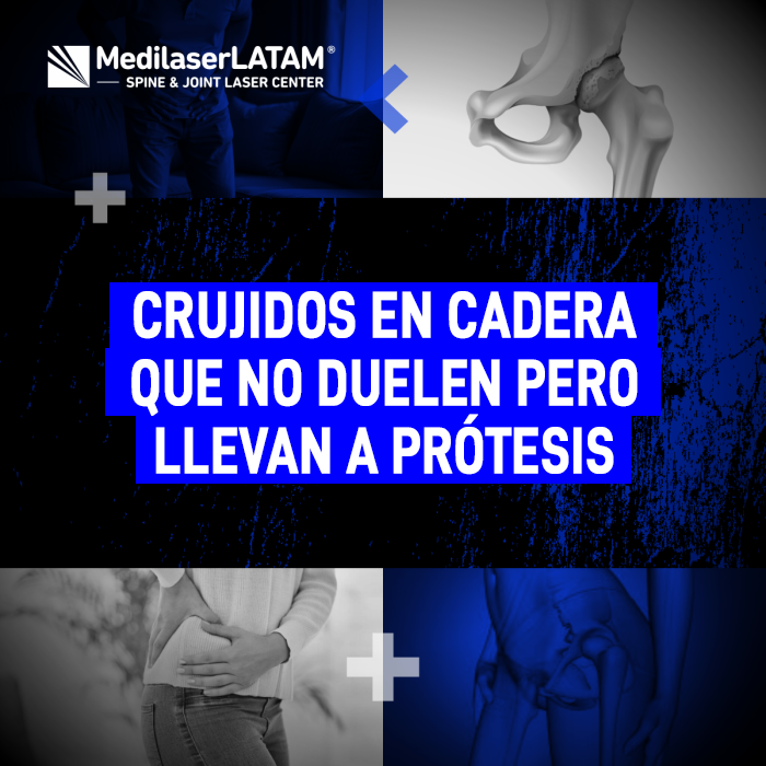 Crujidos en cadera que indican desgaste prematuro. Actúe antes de que el daño sea irreversible y necesite una prótesis de reemplazo.