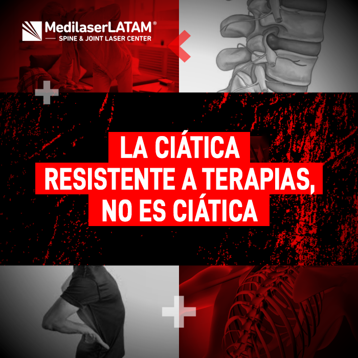 La ciática resistente a terapias no es ciática. Conozca la verdadera causa de su dolor cuando nada parece funcionar.