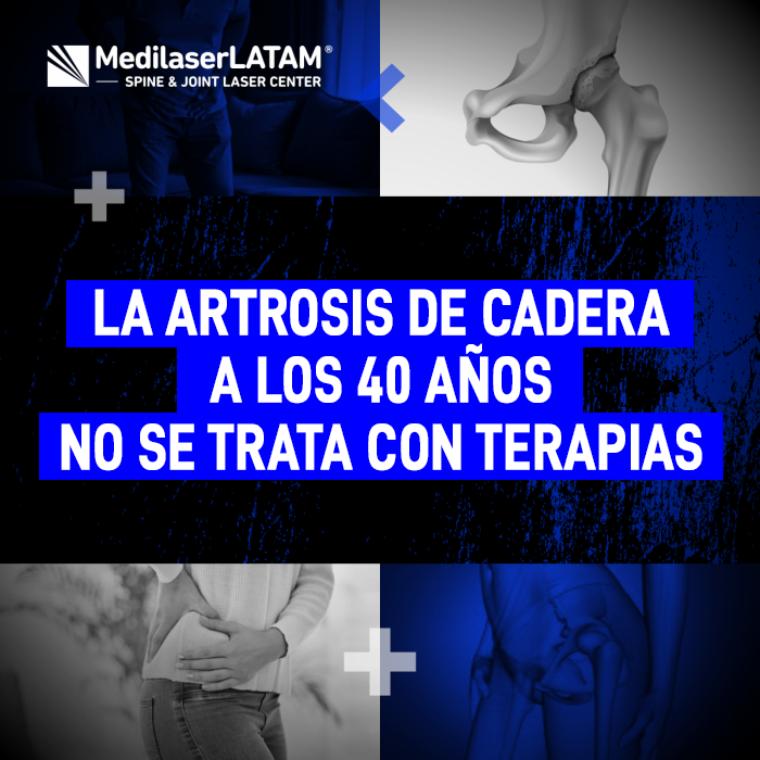 Artrosis de cadera en adultos jóvenes. Descubra por qué las terapias físicas no bastan para frenar el desgaste prematuro de la articulación.