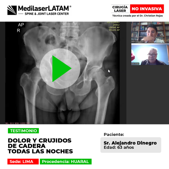 Dolor y Crujidos de Cadera: detén el aplastamiento de tu columna y recupera el sueño con un tratamiento médico láser de alta precisión.