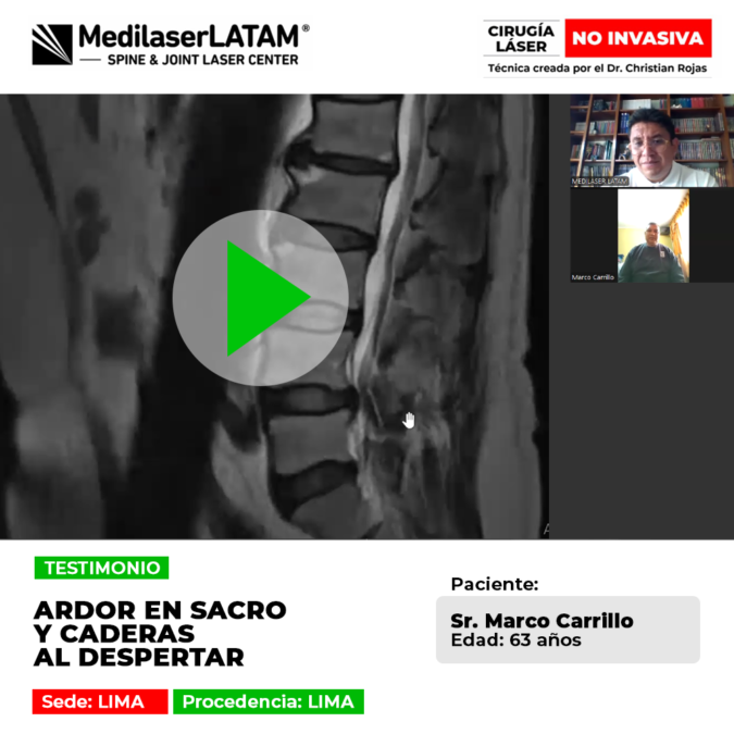 Ardor en sacro y caderas al despertar. Elimine esa sensación de quemazón y rigidez matutina mediante tecnología láser de alta precisión.