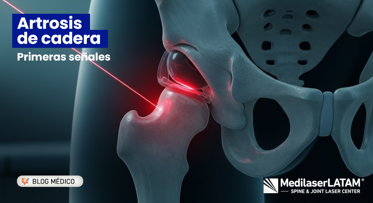 ¿Dolor en la ingle o rigidez al caminar? Conoce los síntomas de artrosis de cadera y cómo frenar el desgaste sin prótesis ni cirugías.