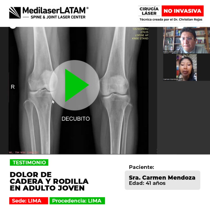 Dolor de Cadera y Rodilla: conoce el tratamiento láser que regenera el cartílago y evita prótesis en adultos jóvenes de forma efectiva.