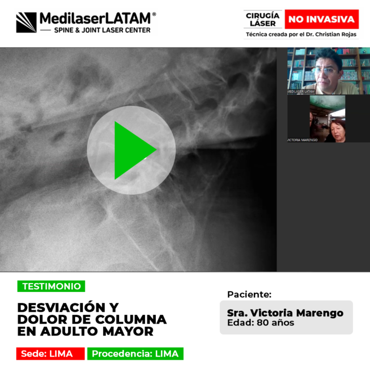 Desviación y dolor de columna en adulto mayor. Mejore su calidad de vida y movilidad con tecnología láser de alta precisión.