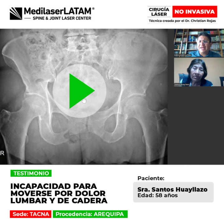 Incapacidad para moverse por dolor lumbar y de cadera. Elimine el origen del malestar sin cirugías invasivas con nuestra técnica láser.