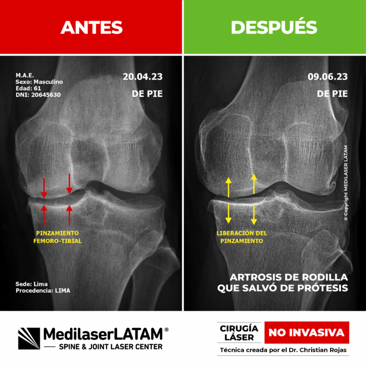 Artrosis de rodilla: evidencia científica de cómo el láser detiene el desgaste articular y elimina el dolor, evitando la prótesis.