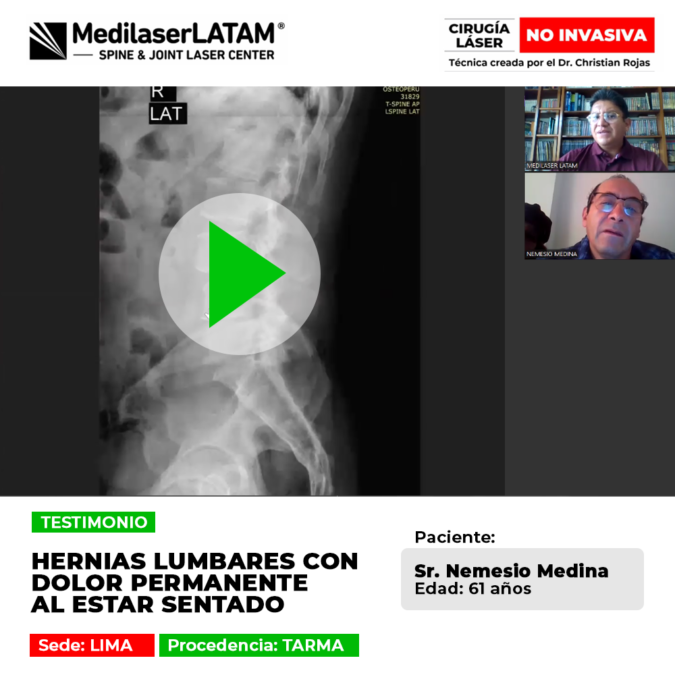 Hernias lumbares: paciente de Tarma recupera su movilidad tras eliminar el dolor permanente al estar sentado con tecnología láser avanzada.