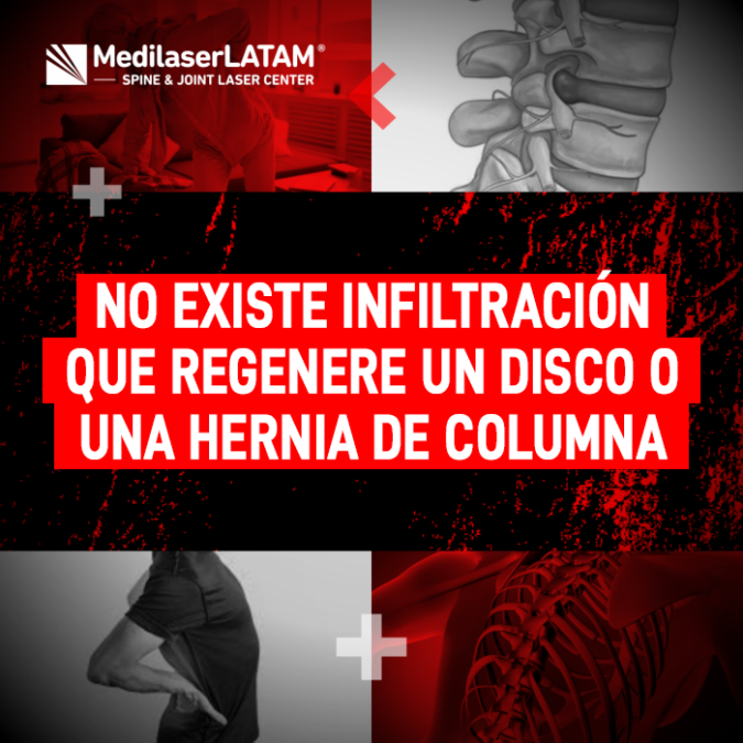 Descubre la realidad sobre las infiltraciones en la columna y conoce por qué no logran la regeneración de un disco dañado.