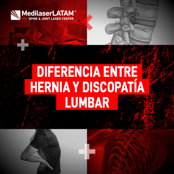 Aprende a distinguir entre una hernia y una discopatía lumbar para entender mejor tu diagnóstico y elegir el tratamiento correcto.