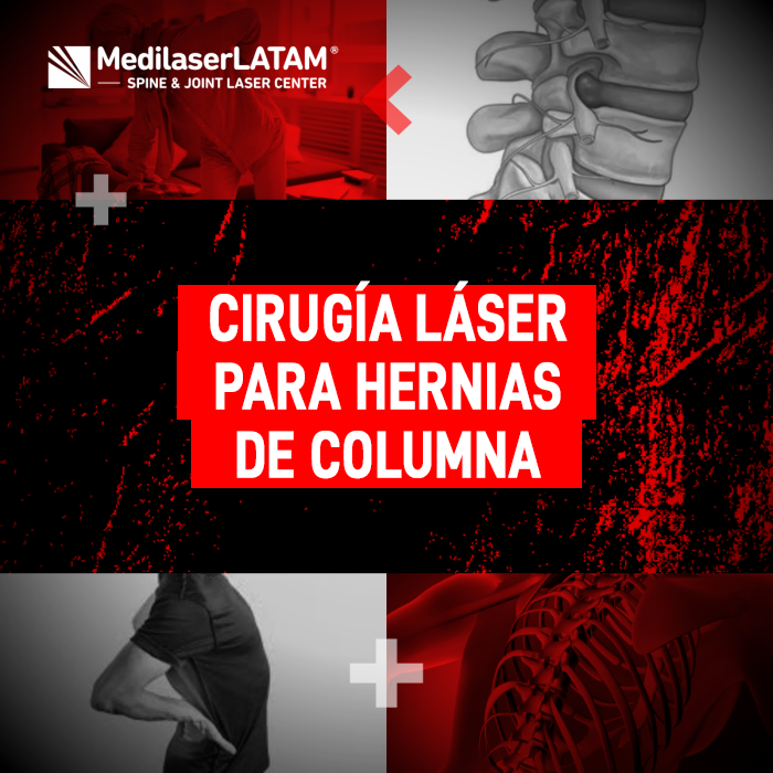 La tecnología láser ofrece una alternativa moderna para tratar hernias de columna sin cirugías abiertas. Recupera tu bienestar físico.