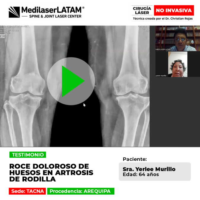 ¿Sientes que tus huesos rozan al caminar? Descubre cómo el tratamiento médico de Medilaser LATAM detiene el desgaste articular sin prótesis.