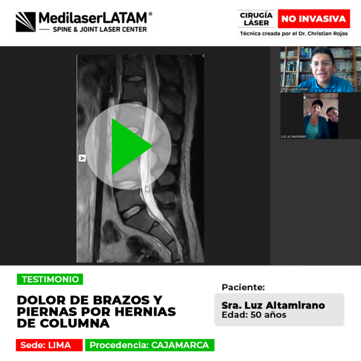 Las hernias pueden irradiar dolor a brazos y piernas. Conoce este procedimiento láser ambulatorio para liberar los nervios de forma segura.