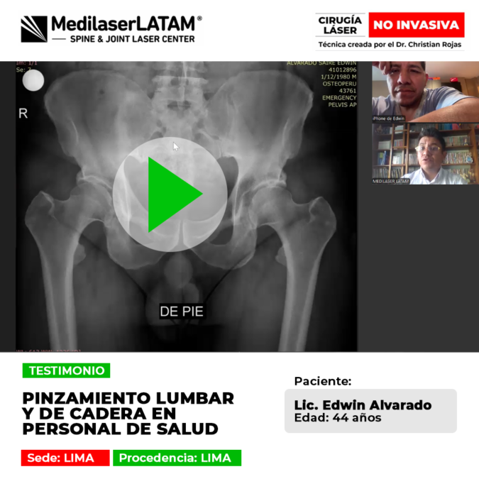El pinzamiento lumbar y de cadera afecta gravemente el desempeño del personal de salud. Descubre la tecnología médica que permite una recuperación rápida y sin cortes.