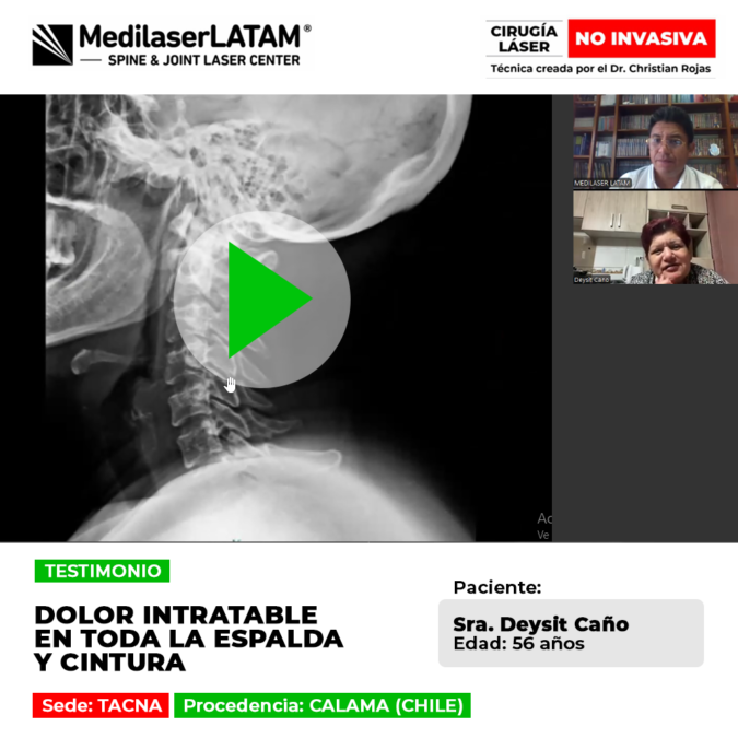 Pon fin al dolor lumbar severo que afecta tu espalda y cintura. Tratamientos láser efectivos para recuperar tu movilidad rápidamente.
