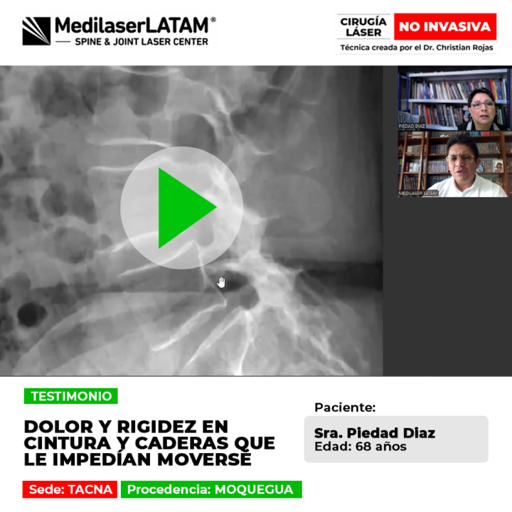 Conoce cómo superar la rigidez en cintura y caderas con tratamientos avanzados. Un testimonio real de recuperación y movilidad.