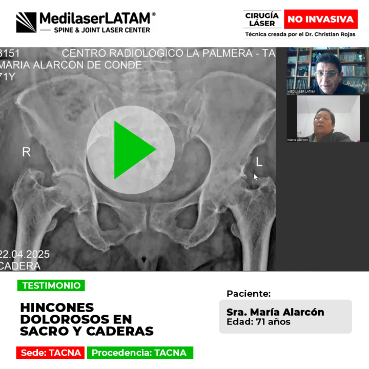 Supera las punzadas y el dolor severo en la zona del sacro y caderas. Conoce este tratamiento efectivo para recuperar tu bienestar.