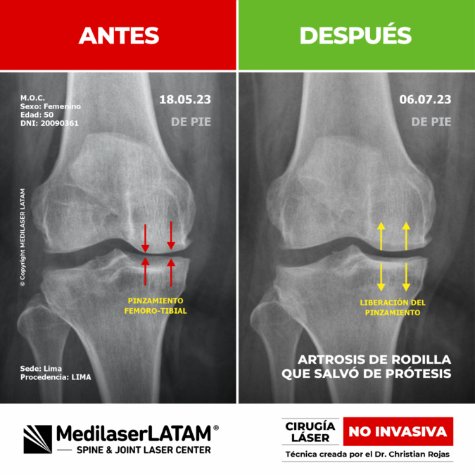 Evidencia científica de artrosis de rodilla avanzada que logró evitar la prótesis gracias al tratamiento de Cirugía Láser NO INVASIVA.