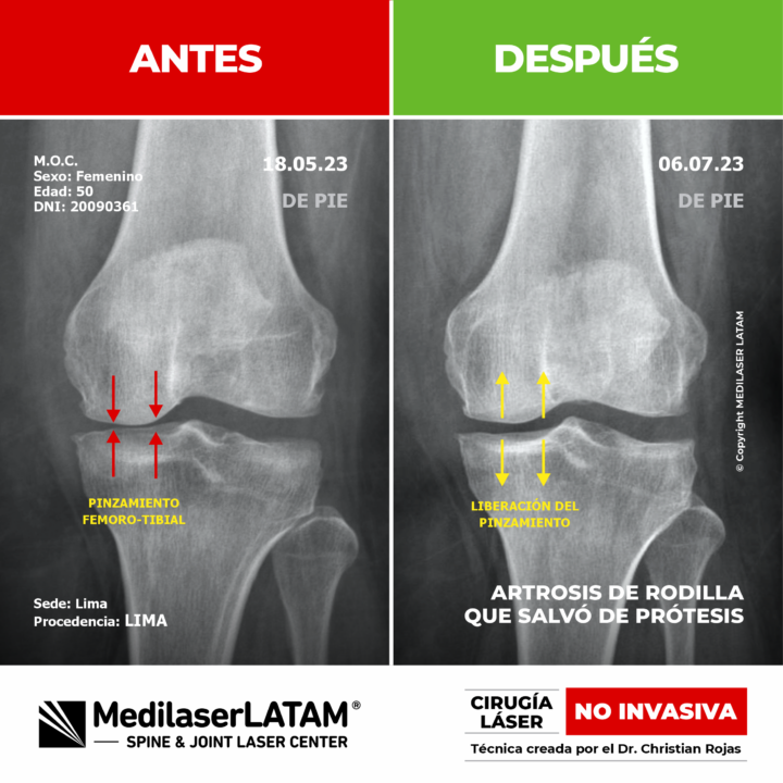 Documentación clínica de regeneración articular en rodilla. Cómo la tecnología láser ayuda a pacientes a evitar cirugías de prótesis.