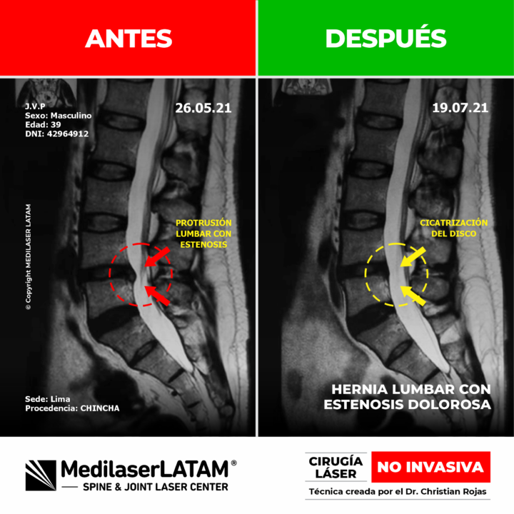 Evidencia de descompresión en hernia lumbar con estenosis dolorosa. Alivio del dolor de espalda con Cirugía Láser avanzada NO INVASIVA.